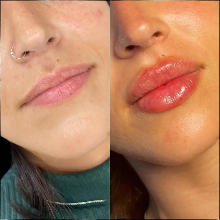 Best Doctors in Dubai for Lip Fillers: Top Choices